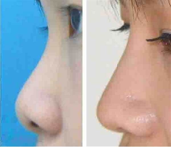 肋軟骨<a href=http://www.f3bb6.cn/listinfo-737-0.html target=_blank class=infotextkey>隆鼻</a>效果好嗎