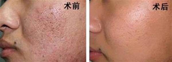 如何祛痘痕
