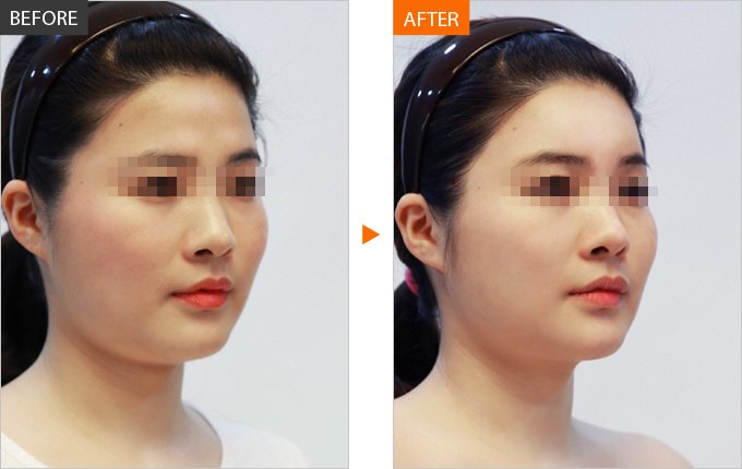 膠原蛋白針劑<a href=http://www.f3bb6.cn/listinfo-643-0.html target=_blank class=infotextkey>豐額頭</a>效果好不好