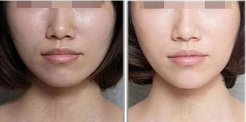 光子<a href=http://www.f3bb6.cn/listinfo-770-0.html target=_blank class=infotextkey>嫩膚</a>的價格是多少