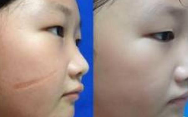 激光<a href=http://www.f3bb6.cn/listinfo-783-0.html target=_blank class=infotextkey>祛疤</a>多少錢