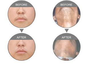 光子<a href=http://www.f3bb6.cn/listinfo-663-0.html target=_blank class=infotextkey>面部<a href=http://www.f3bb6.cn/listinfo-670-0.html target=_blank class=infotextkey>脫毛</a></a>多少錢