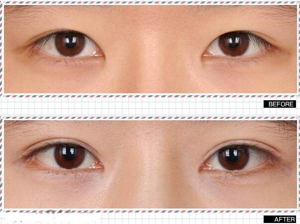 做<a href=http://www.f3bb6.cn/listinfo-724-0.html target=_blank class=infotextkey>雙眼皮</a>什么季節好得快