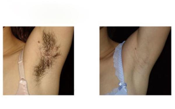 激光<a href=http://www.f3bb6.cn/listinfo-670-0.html target=_blank class=infotextkey>脫毛</a>的價錢