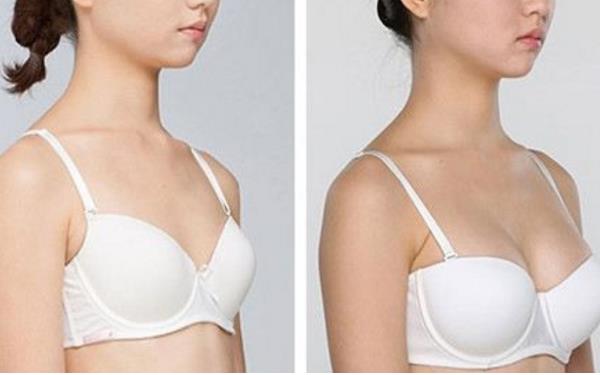 自體脂肪<a href=http://www.f3bb6.cn/listinfo-618-0.html target=_blank class=infotextkey>隆胸</a>整形費用