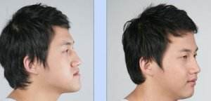 骨性<a href=http://www.f3bb6.cn/listinfo-641-0.html target=_blank class=infotextkey>地包天矯正</a>費(fèi)用