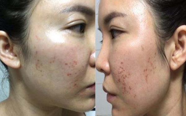 <a href=http://www.f3bb6.cn/listinfo-768-0.html target=_blank class=infotextkey>微針</a>可以去痘坑嗎