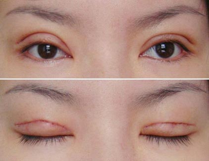  <a href=http://www.f3bb6.cn/listinfo-724-0.html target=_blank class=infotextkey>雙眼皮</a>緊繃軟化涂什么