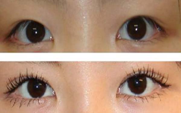 埋線眼睛黑紫怎么消腫呢