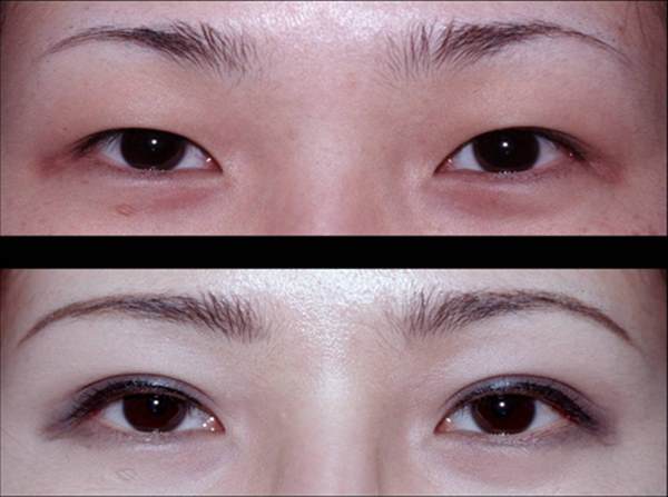 眉毛結痂要癢幾天才可以好