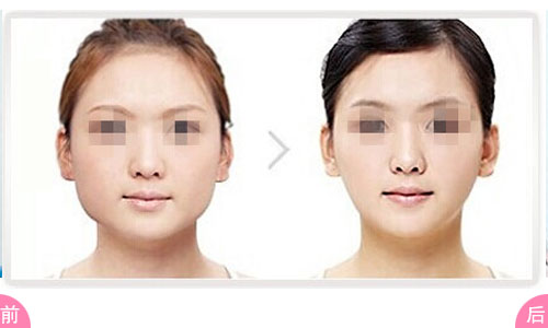 <a href=http://www.f3bb6.cn/listinfo-631-0.html target=_blank class=infotextkey>瘦臉</a><a href=http://www.f3bb6.cn/listinfo-614-0.html target=_blank class=infotextkey>除皺</a>多久效果比較好呢