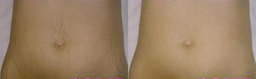 肚子上妊辰紋怎么消除