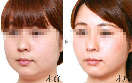 <a href=http://www.f3bb6.cn/listinfo-631-0.html target=_blank class=infotextkey>瘦臉</a><a href=http://www.f3bb6.cn/listinfo-614-0.html target=_blank class=infotextkey>除皺</a>第二針隔多久打