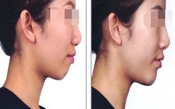 <a href=http://www.f3bb6.cn/listinfo-631-0.html target=_blank class=infotextkey>瘦臉</a><a href=http://www.f3bb6.cn/listinfo-614-0.html target=_blank class=infotextkey>除皺</a>打完臉僵硬多久