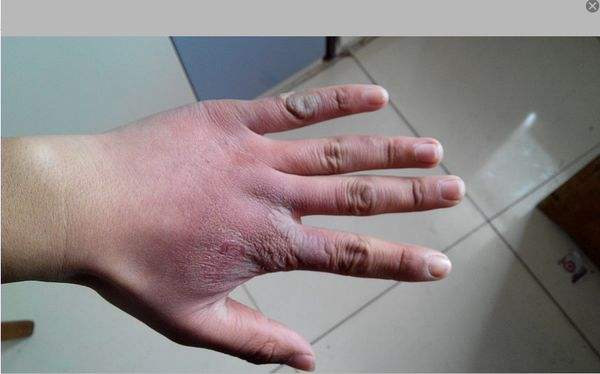 凍瘡疤痕怎么消除