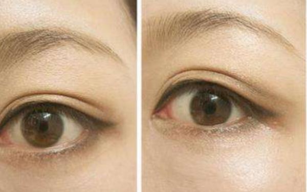 無痕<a href=http://www.f3bb6.cn/listinfo-724-0.html target=_blank class=infotextkey>雙眼皮</a>要多少錢