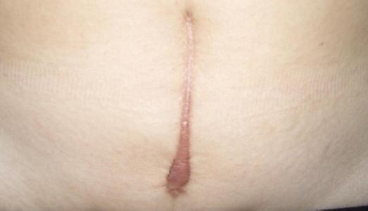  剖腹產增生疤痕切除