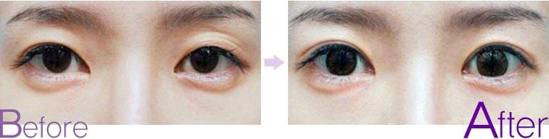 <a href=http://www.f3bb6.cn/listinfo-711-0.html target=_blank class=infotextkey>開眼角</a>手術大概多少錢