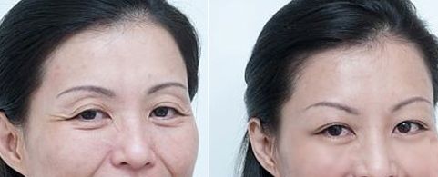 靜態(tài)紋怎么去除