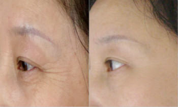 魚尾紋<a href=http://www.f3bb6.cn/listinfo-614-0.html target=_blank class=infotextkey>除皺</a>優(yōu)點有哪些