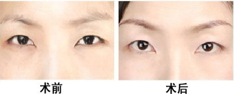 紋眉麻藥過敏怎么辦