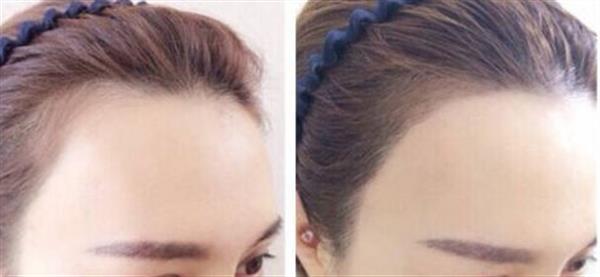 發際線整形真的是長期有效的嗎