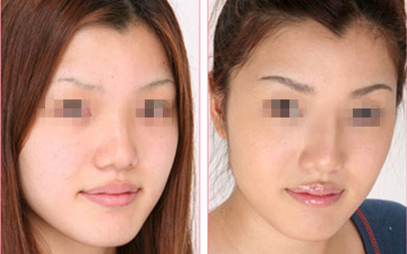 膨體墊鼻子多少錢