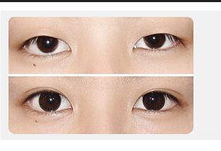 割<a href=http://www.f3bb6.cn/listinfo-724-0.html target=_blank class=infotextkey>雙眼皮</a>有年齡限制嗎