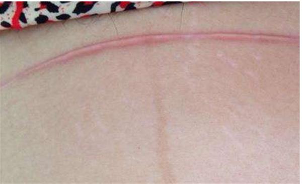 二次剖腹產疤痕效果好嗎