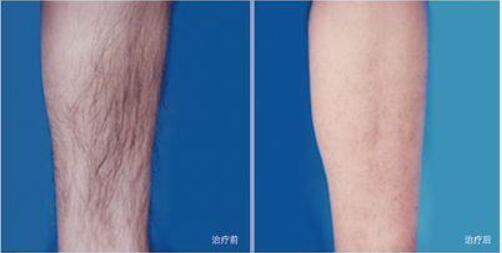 做完冰點<a href=http://www.f3bb6.cn/listinfo-670-0.html target=_blank class=infotextkey>脫毛</a>注意什么