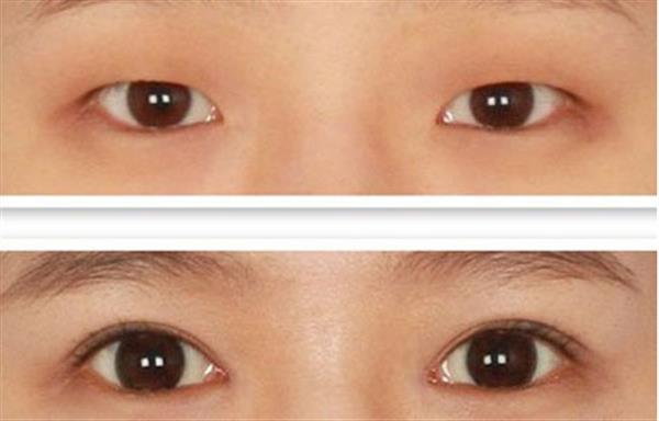 多層褶皺<a href=http://www.f3bb6.cn/listinfo-724-0.html target=_blank class=infotextkey>雙眼皮</a>怎么樣