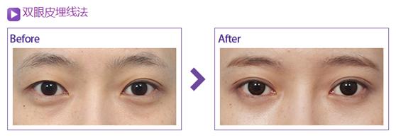 杭州埋線<a href=http://www.f3bb6.cn/listinfo-724-0.html target=_blank class=infotextkey>雙眼皮</a>價格