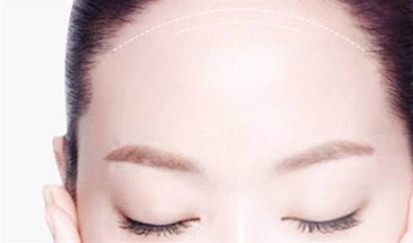 額頭填充術(shù)<a href=http://www.f3bb6.cn/listinfo-643-0.html target=_blank class=infotextkey>豐額頭</a>效果明不明顯