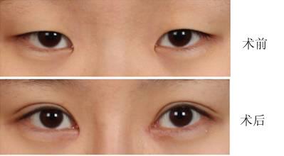 <a href=http://www.f3bb6.cn/listinfo-724-0.html target=_blank class=infotextkey>雙眼皮</a>修復的手術方法有哪些