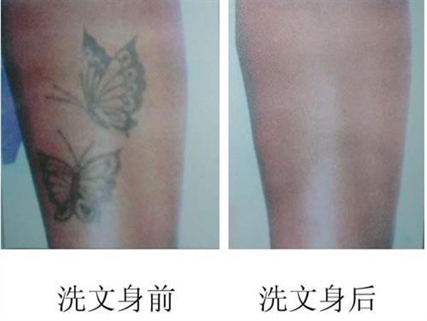 激光<a href=http://www.f3bb6.cn/listinfo-793-0.html target=_blank class=infotextkey>洗紋身</a>能用麻藥嗎