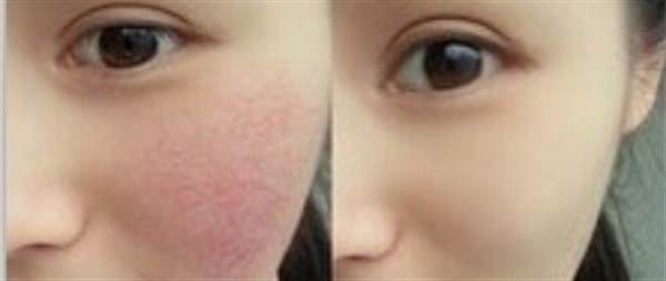 激光<a href=http://www.f3bb6.cn/listinfo-772-0.html target=_blank class=infotextkey>去紅血絲</a>會反彈嗎