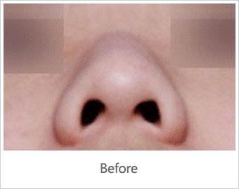 廣東<a href=http://www.f3bb6.cn/listinfo-753-0.html target=_blank class=infotextkey>鼻頭縮小</a>術價格