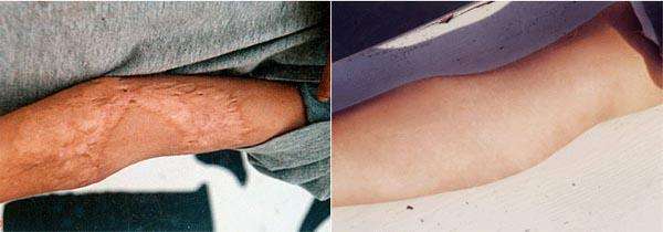 燒傷疤痕的治療時(shí)間