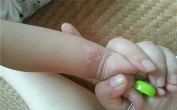 <a href=http://www.f3bb6.cn/listinfo-783-0.html target=_blank class=infotextkey>祛疤</a>痕有效方法