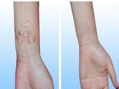 燒傷疤痕輕松去除的好方法