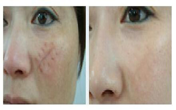 哪里去疤痕較好?