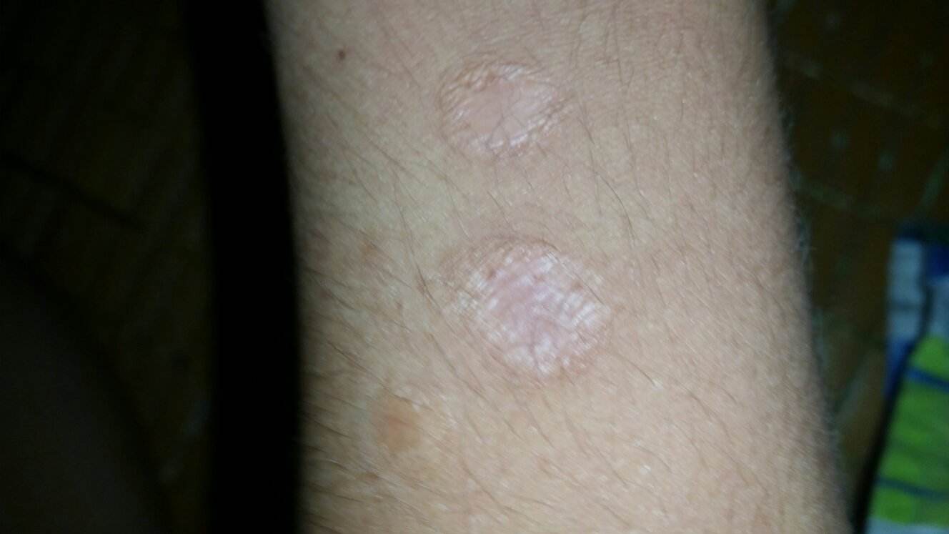 注射<a href=http://www.f3bb6.cn/listinfo-783-0.html target=_blank class=infotextkey>祛疤</a>有沒有并發癥