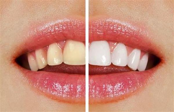 種植牙要準備些什么