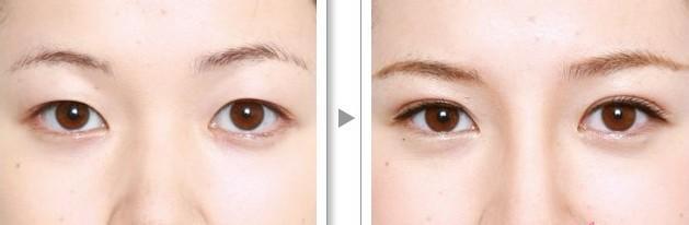 <a href=http://www.f3bb6.cn/listinfo-724-0.html target=_blank class=infotextkey>雙眼皮</a>加<a href=http://www.f3bb6.cn/listinfo-711-0.html target=_blank class=infotextkey>開眼角</a>費用大致是多少