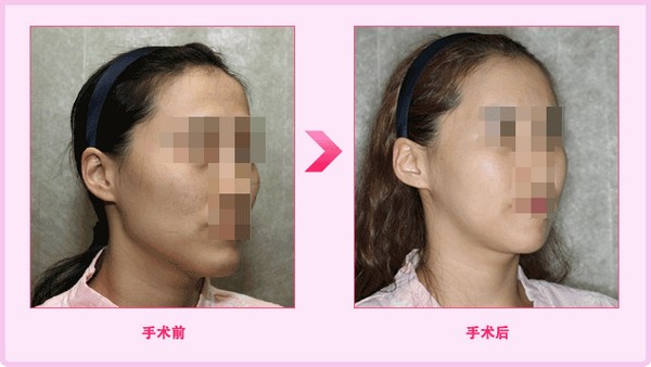 臉兩側骨頭突出怎么辦