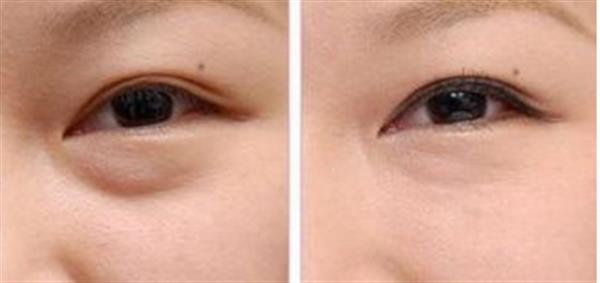 眼袋手術失敗怎么辦