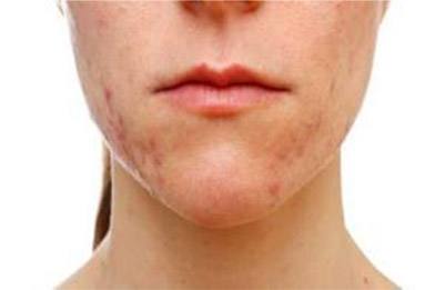 激光<a href=http://www.f3bb6.cn/listinfo-797-0.html target=_blank class=infotextkey>去痘疤</a>的治療過程是怎樣的