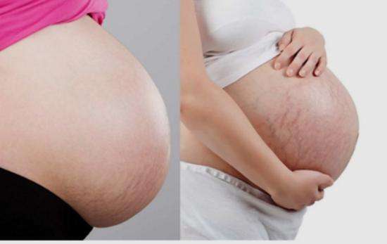 妊娠紋可以通過激光的方法祛除嗎?