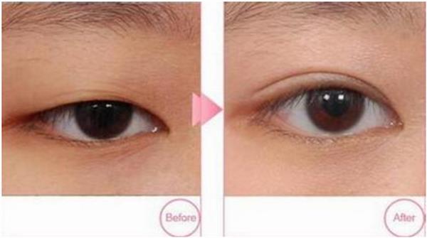 <a href=http://www.f3bb6.cn/listinfo-724-0.html target=_blank class=infotextkey>雙眼皮</a>全切好嗎