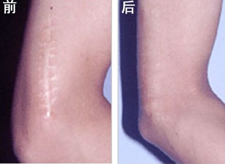 怎樣區分疤痕的種類